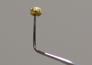 金箔による虫歯治療