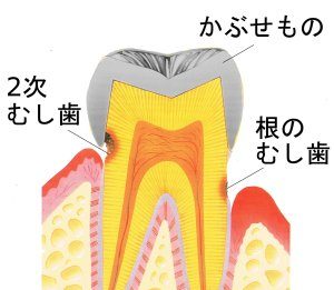 二次虫歯や根の虫歯