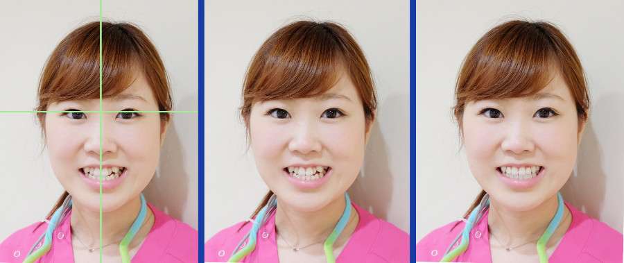 審美歯科 術前の診断