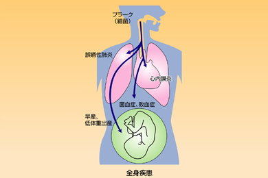 歯周病の全身への影響