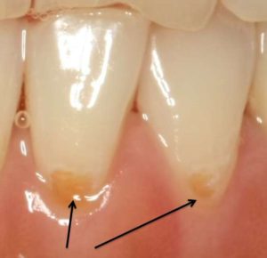 進行性の色が薄い虫歯