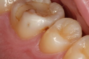 詰めものの2次虫歯と接触点の虫歯